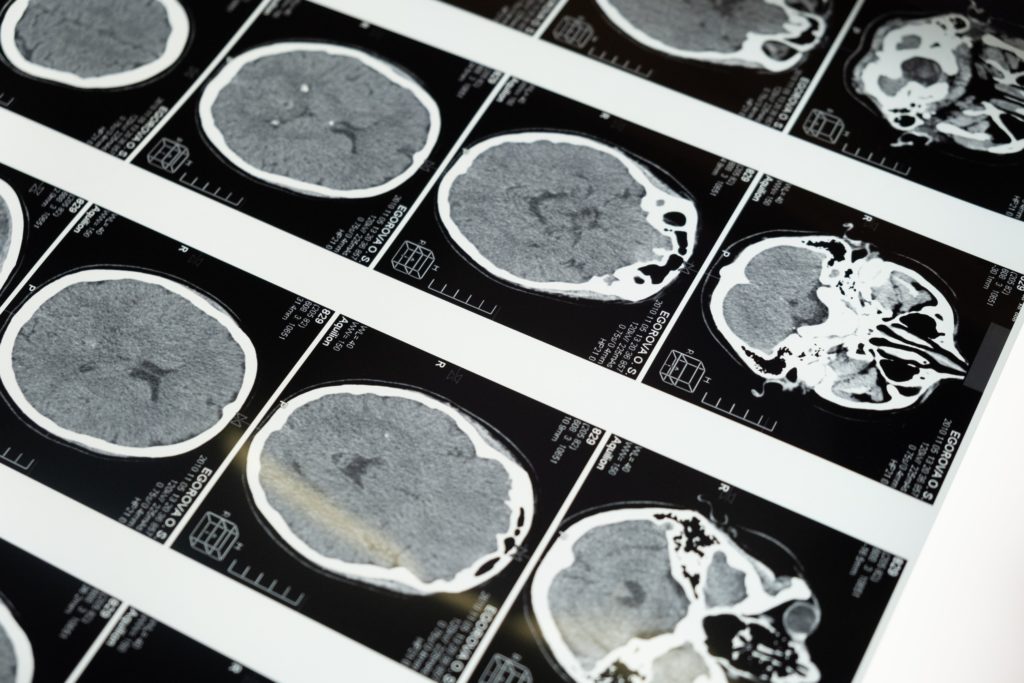 Brain Scans for potential TBI patient, traumatic brain injury. 
